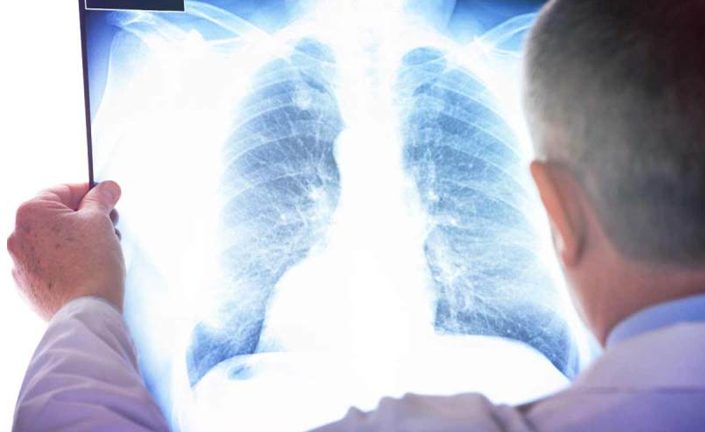 злокачественная мезотелиома плевры