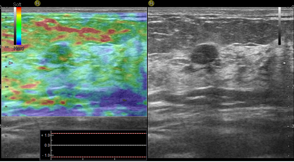 Рис.10 Эластограмма эластичного образования – фиброаденомы молочной железы