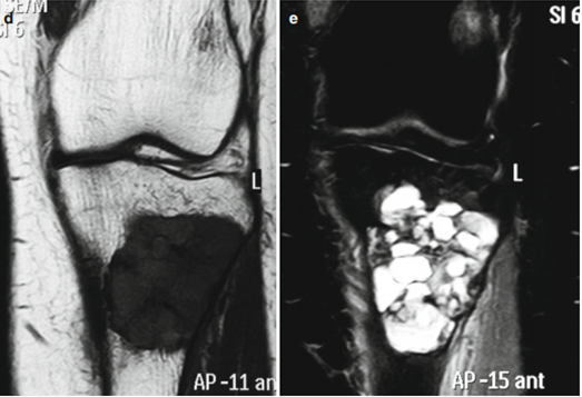 Рис.4: Компьютерная томография: визуализируются образования большеберцовой кости в виде гиподенсных масс, в которых прослеживается кистозная структура