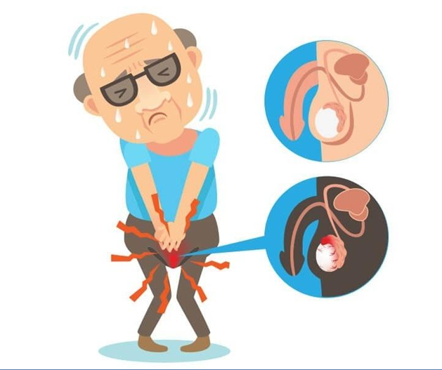 Опухоль яичка Опухоль яичка