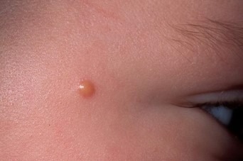 Внутридермальный