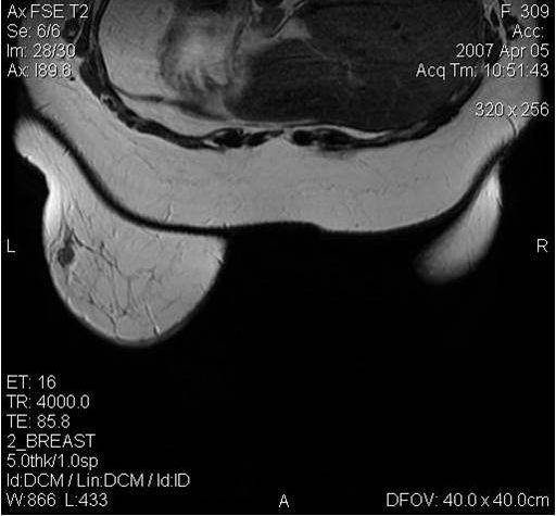МРТ-диагностика рака молочной железы
