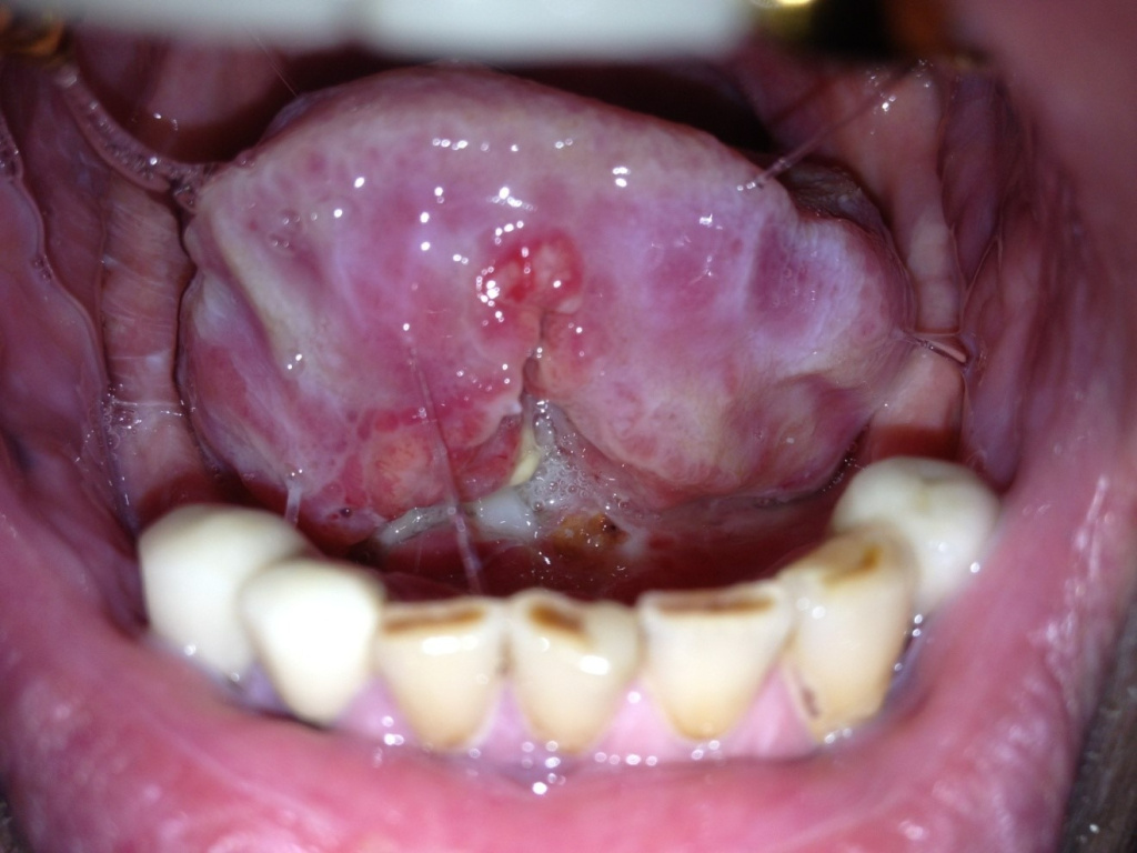 Фото первичной опухоли