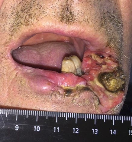 Фото рака губы