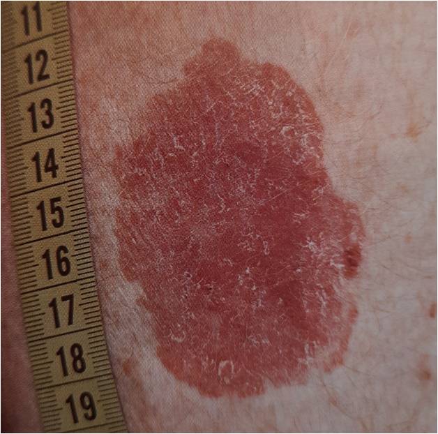 кожный рак in situ