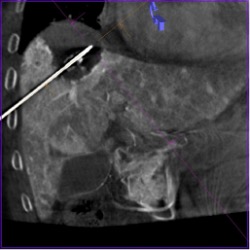 Микроволновая абляция