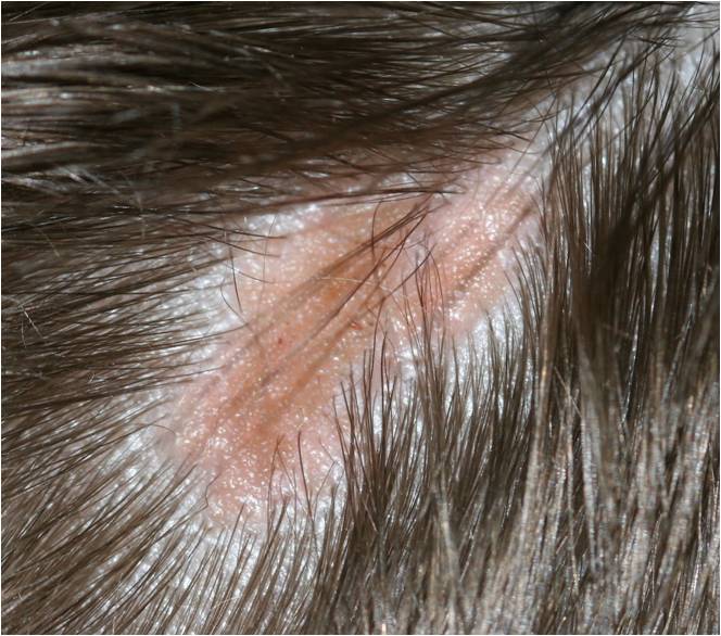 невус сальных желез