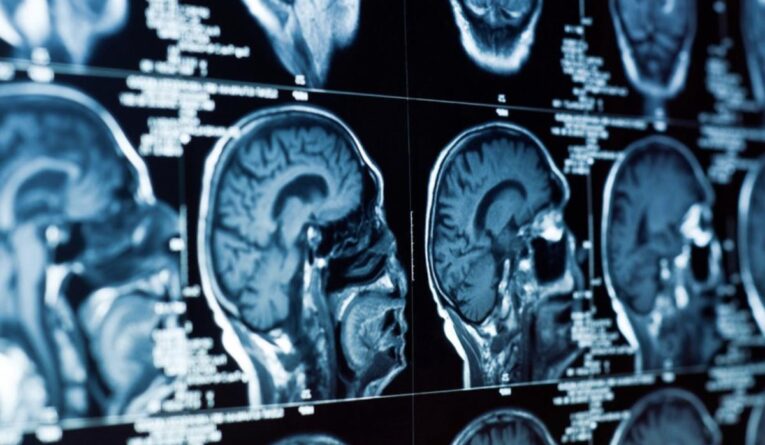 Опухоли слюнных желез