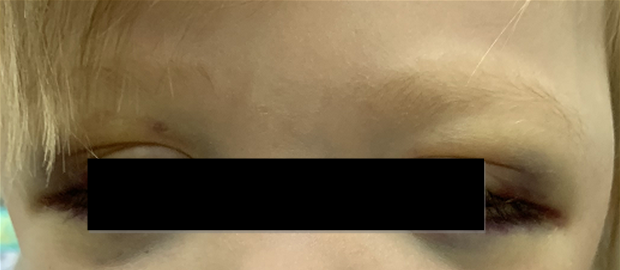 Рис. 3.2. Симптом «очков» при метастазах в орбиту