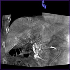 Пример, демонстрирующий выраженные артефакты движенияе