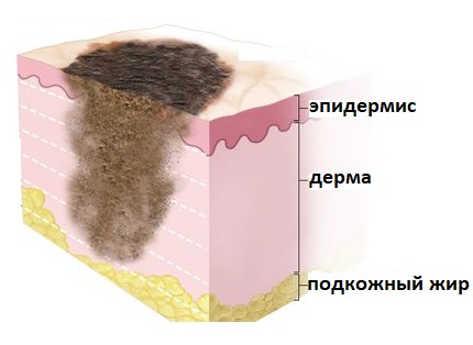 Глубина прорастания меланомы в кожу