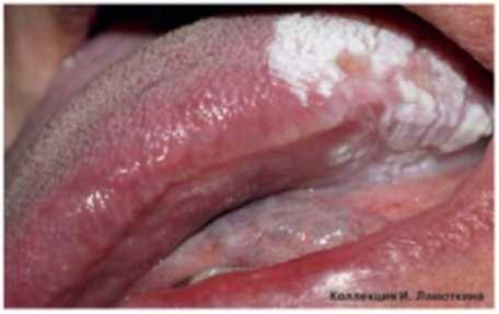 лейкоплакия