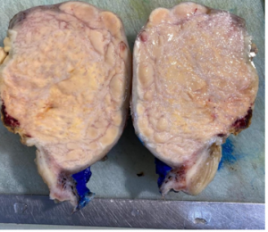 Рис. 3 Макропрепарат после экстирпации матки (эндометриальная стромальная саркома) Рис. 3 Макропрепарат после экстирпации матки (эндометриальная стромальная саркома)