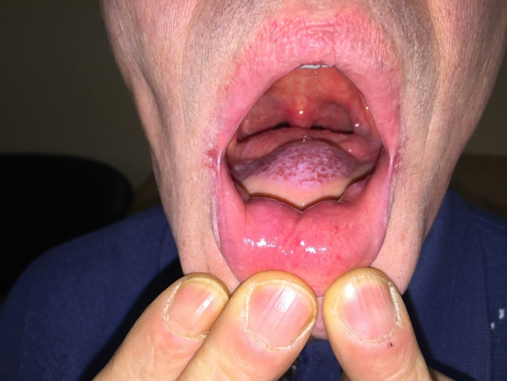 Удаление опухоли