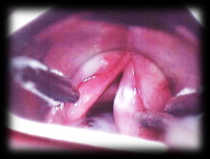 Лейкоплакия