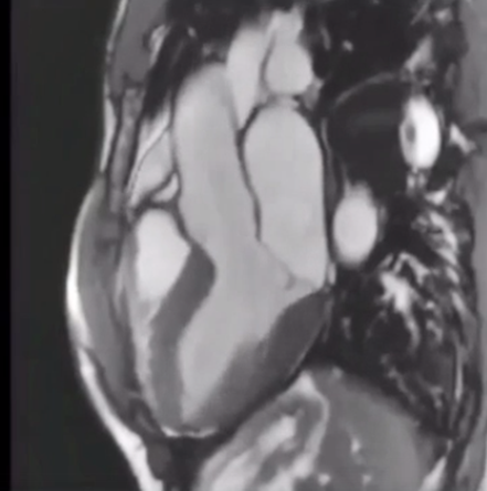 Магнитно-резонансная томография сердца (cardiovascular magnetic resonance или CMR)