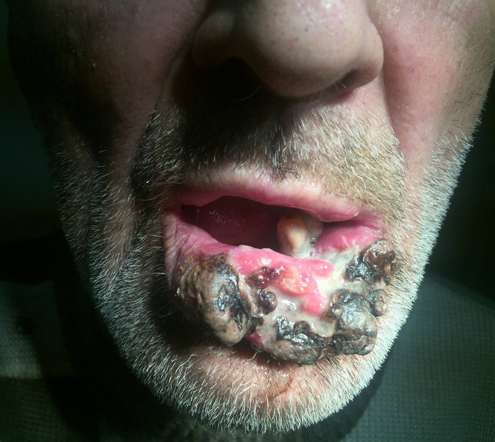 Фото рака губы