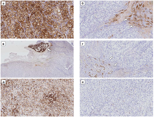 иммуногистохимические маркеры иммуногистохимические маркеры