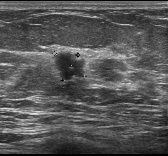 Рис.7 Эхограмма участка аденоза молочной железы