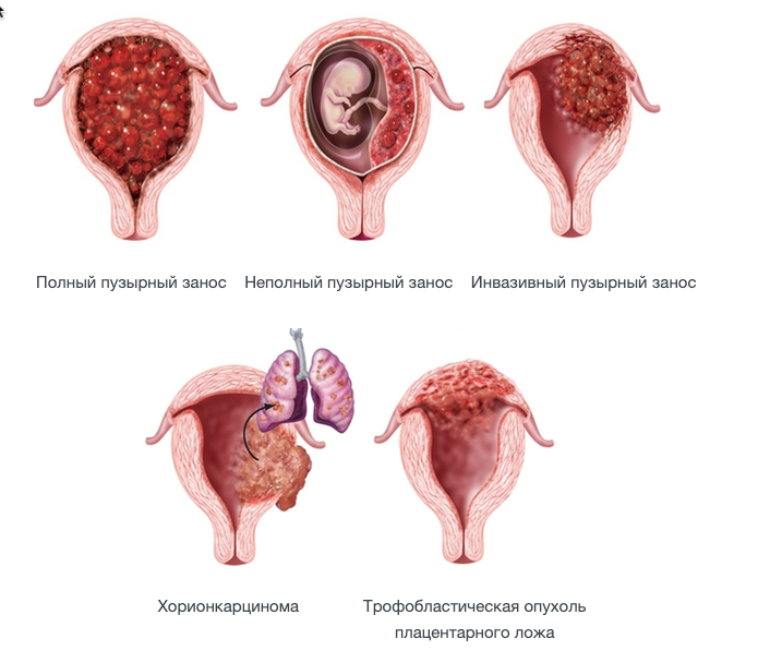 Пузырный занос