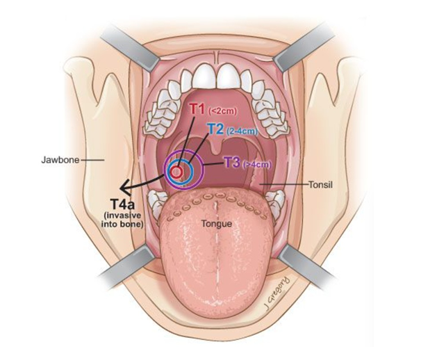 Стадирование рака миндалины по размеру опухоли – «Т» Стадирование рака миндалины по размеру опухоли – «Т»