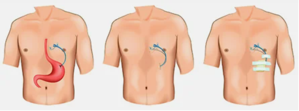 чрескожная эндоскопическая гастростомия
