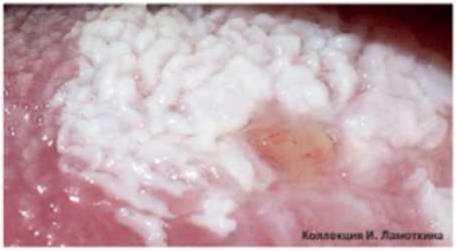 лейкоплакия