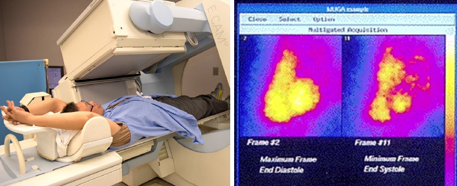 Радионуклидная равновесная вентрикулография (nuclear cardiac imaging или MUGA)