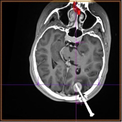 Стереотаксическая биопсия опухоли