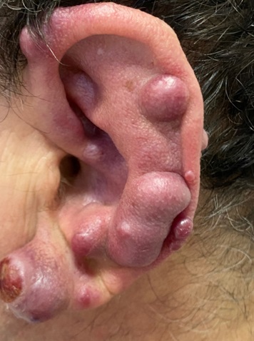 Саркома Капоши Саркома Капоши