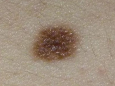 Врожденный мелкий меланоцитарный невус