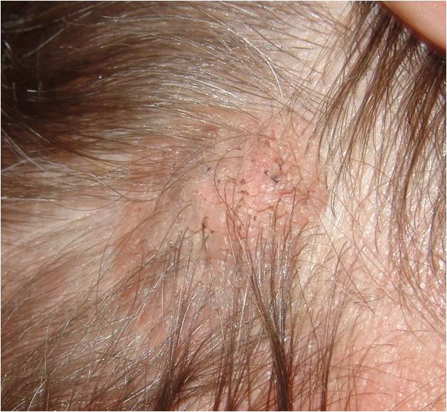 невус сальных желез