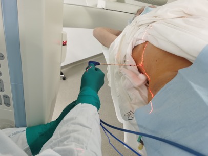 Введение антенны для микроволновой абляции