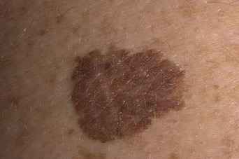 Пигментный