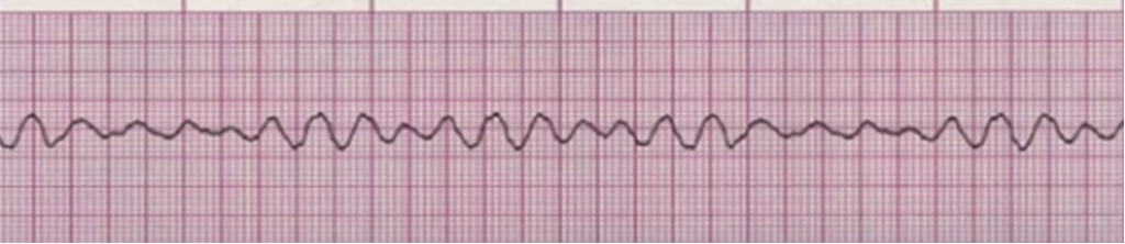 фибрилляция желудочков (рассматривается как непосредственная причина внезапной сердечной смерти)