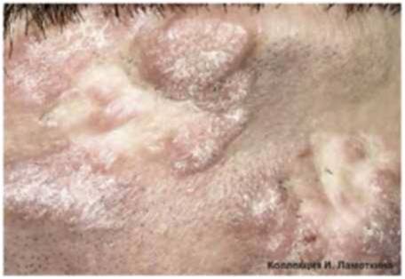 кератоз предраковый