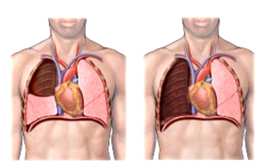 Лобэктомия и пневмонэктомия