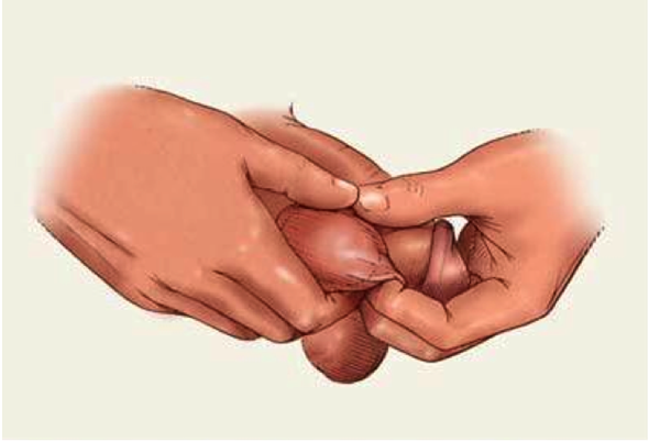 Самообследование яичек Самообследование яичек