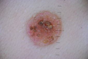 Сложный атипичный невус