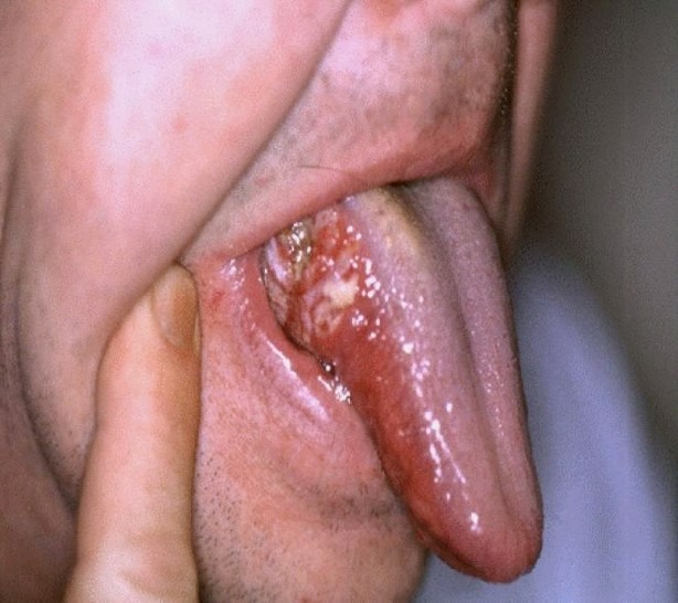 Болезнь Боуэна