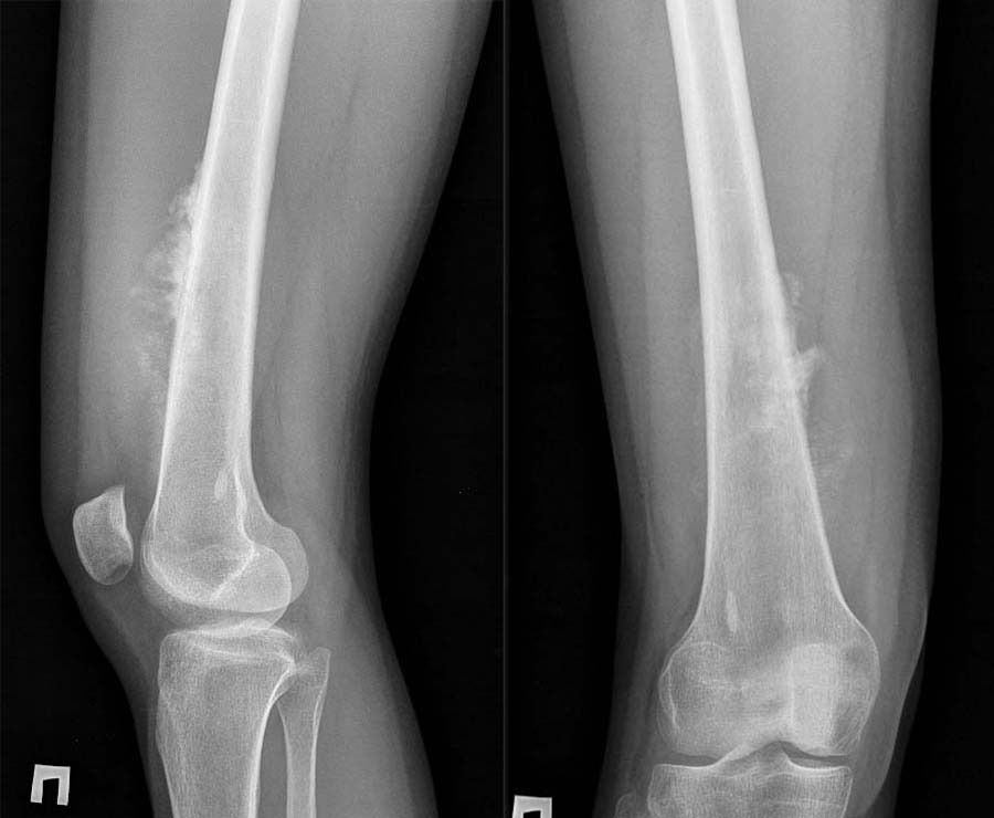 Rg при остеогенной саркоме