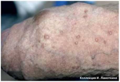 папулез бовеноидный
