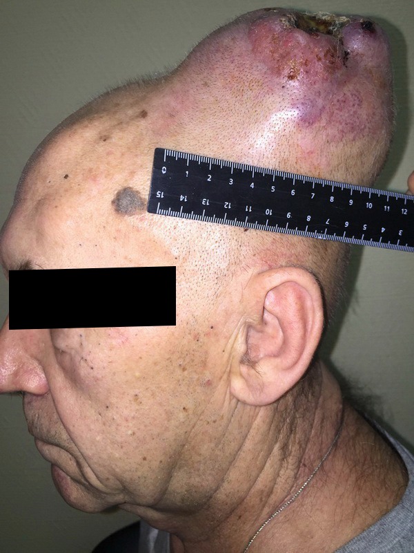 саркома мягких тканей