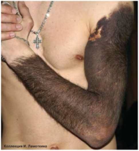 Невусы меланоцитарные