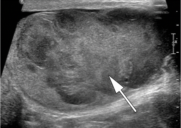 Снимок УЗИ яичка Снимок УЗИ яичка