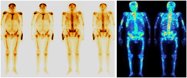 Остеосцинтиграфия Остеосцинтиграфия