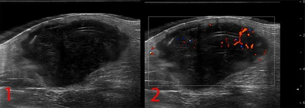 УЗИ опухолей