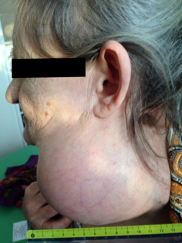 саркома мягких тканей