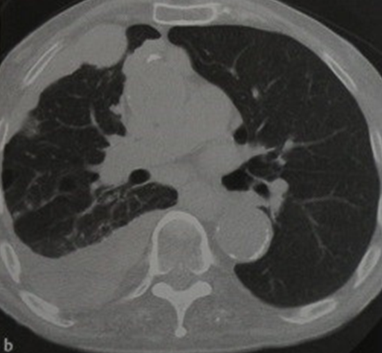 Мезатилиома. Компьютерная томография