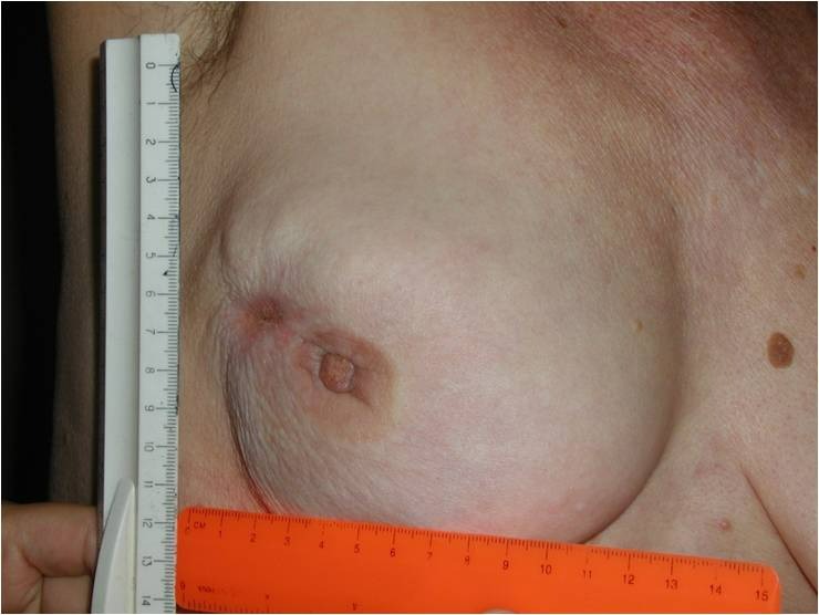 Как выглядит рак груди